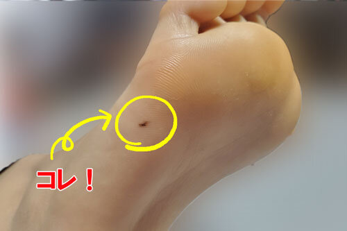足のほくろ