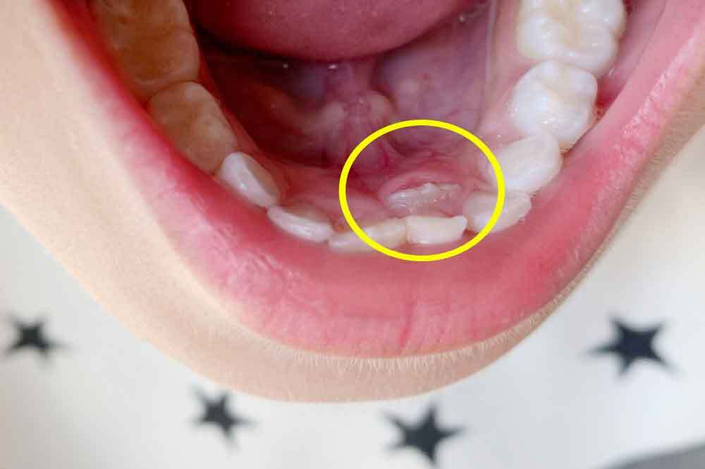 乳歯の後ろに永久歯が生えてきた子供