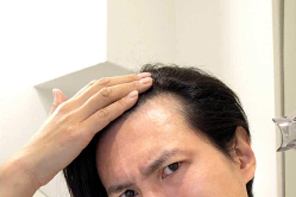 M字が薄くなった男性
