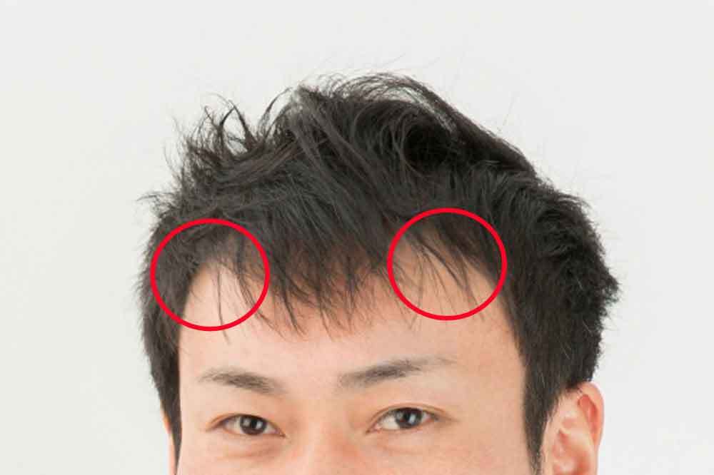 M字部分の前髪に隙間ができる男性