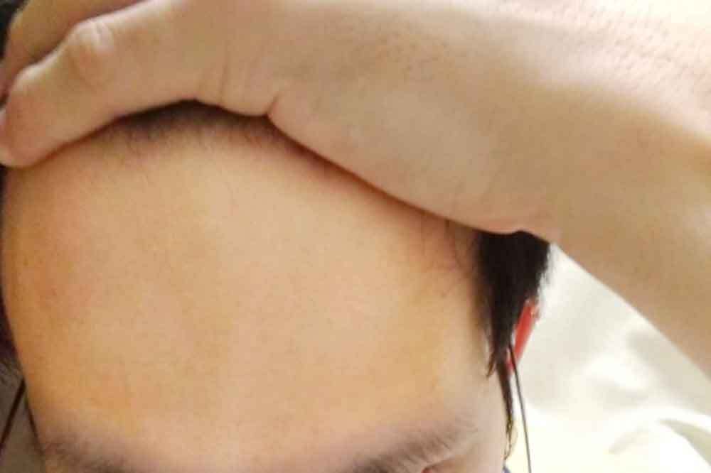 もともとおでこが広い男性