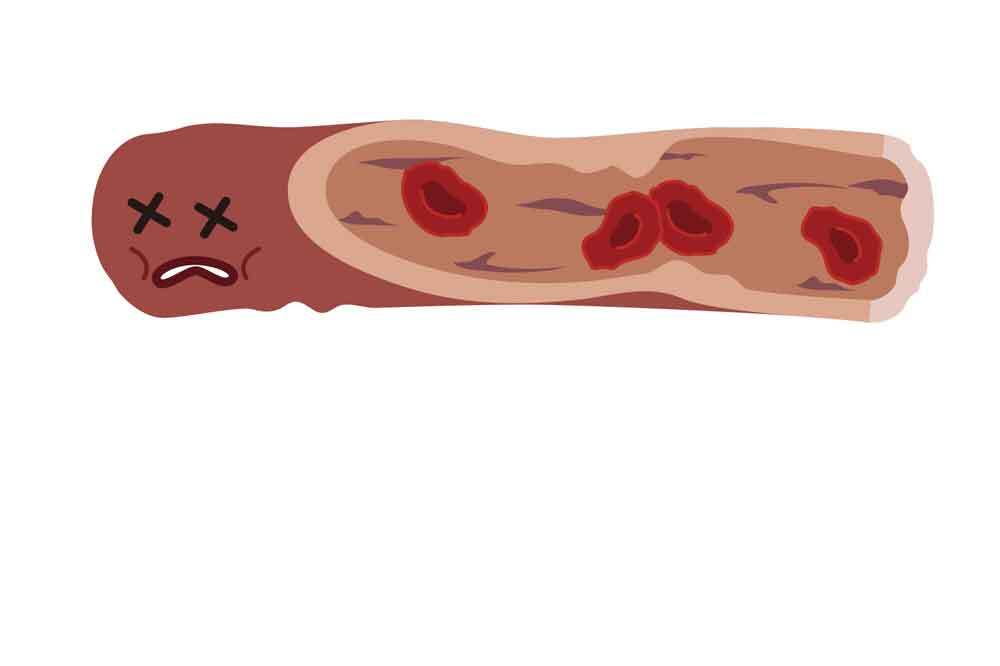 血流の悪い血管
