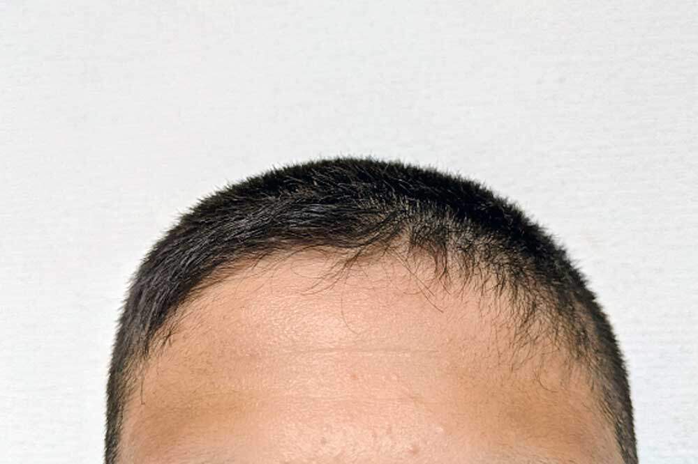 坊主にしても髪は太くならない