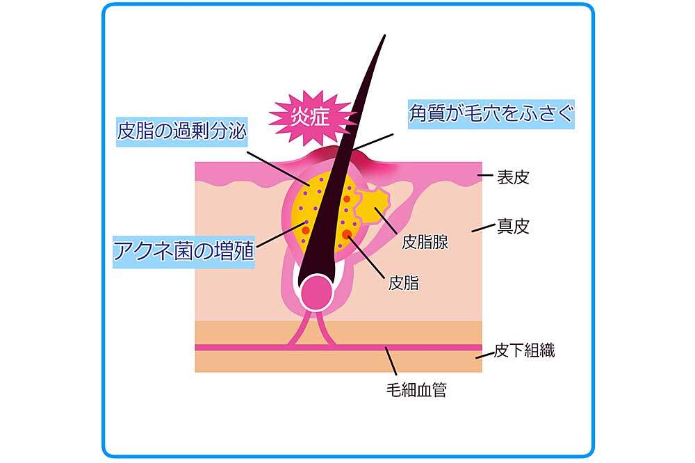 ニキビができる原因