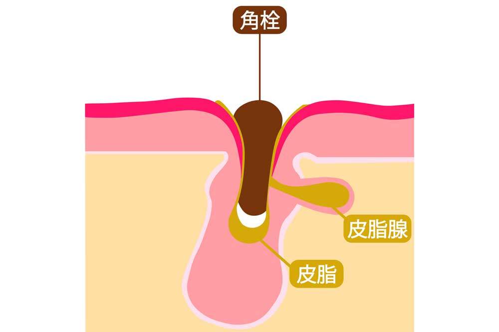 毛穴が開く原因は角栓